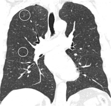 Visual Emphysema At Chest Ct In Gold Stage 0 Cigarette Smokers Predicts