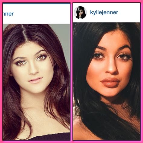 Before And After Of Kylie Jenner Kylie Before And After Celebrities Before And After Kylie