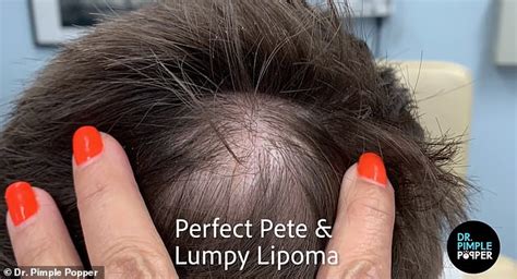 Dr Pimple Popper Removes A Six Year Old Lump Of Fat From Mans Head