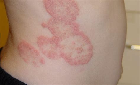 Painful Fungal Infections Causes Symptoms And Treatments