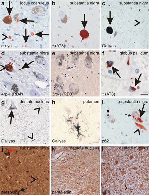 A Lewy Bodies Arrows And Lewy Neurites Arrowhead Are Detected In