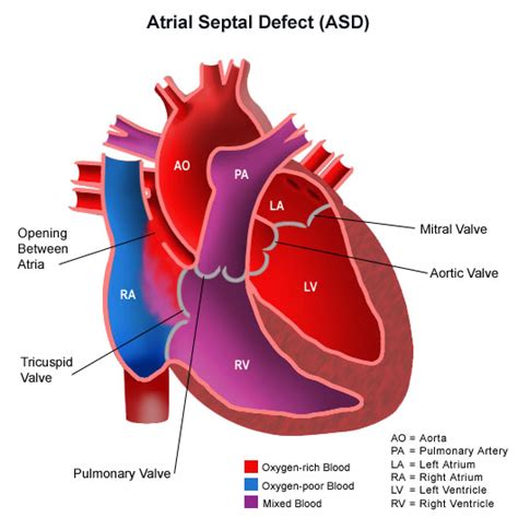 Atrial Septal Defect Asd