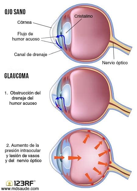 Glaucoma S Ntomas Tipos Causas Y Tratamiento Md Sa De