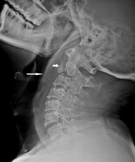 Lateral Radiograph Of The Cervical Spine Shows A Fracture In The Body