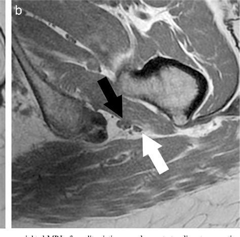 Detection And Prevalence Of Variant Sciatic Nerve Anatomy In Relation To The Piriformis Muscle