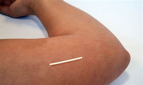 How Long Does It Take For Nexplanon To Work • The Implant Can Remain Under Your Skin For 3