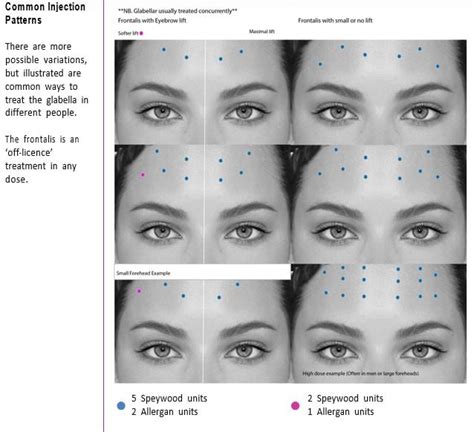 Botox For Eyebrow Lift Technique