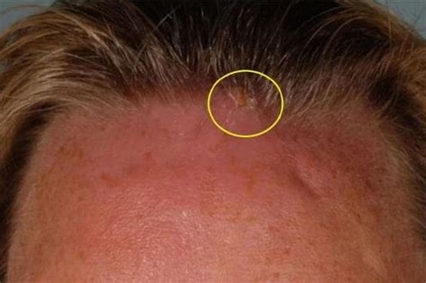 Womans Horror After Holiday Bug Bite On Forehead Turned Into Sinister