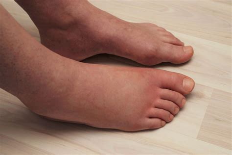 Control Edema Say No To Swelling Sierra Foot And Ankle
