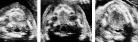 Prenatal Sonographic Features Of Isolated Cleft Soft Palate With