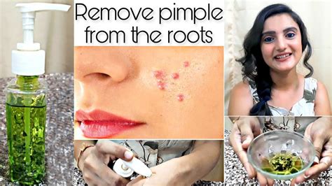 How To Remove Pimple Pimple Mark Remove Acne Remove How To Acne