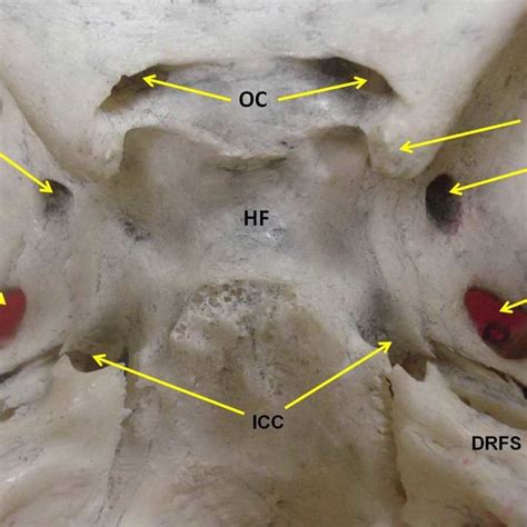 Photograph Of The Middle Cranial Fossa Showing Confluent Foramen Ovale