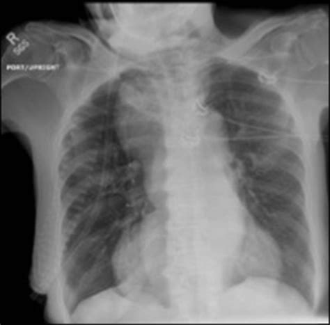 Chest X Ray Depicting Soft Tissue Density In The Right Paratracheal And
