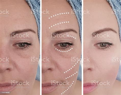 Face Woman Wrinkles Before And After Procedures Stock Photo Download