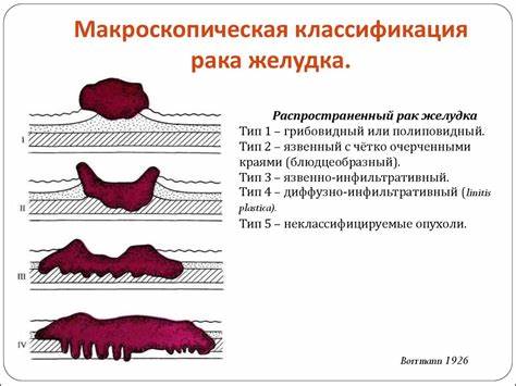 Рак желудка 4 стадии диета Рак желудка. Патология и стадии опухолевого процесса - презентация онлайн Рак желудка. Патология и стадии опухолевого процесса - презентация онлайн Рак желудка 4 стадии диета