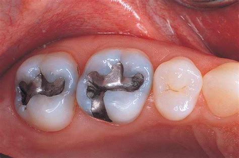 Amalgam Fillings Rickard Dental Centre