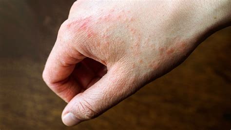 Itchy Red Rash On Hands And Feet Foot Rash Causes Symptoms And