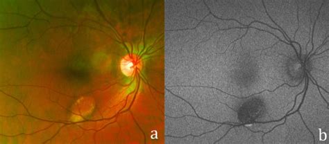 Torpedo Maculopathy—inferior Variant Canadian Journal Of Ophthalmology