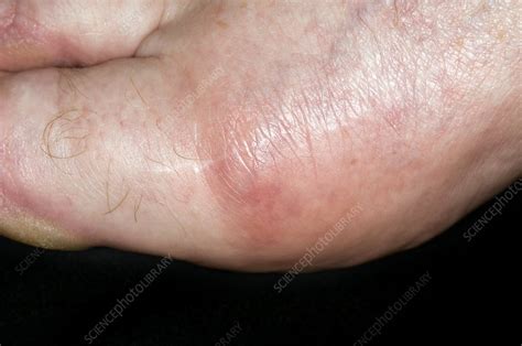 Gout Of The Big Toe Joint Stock Image C0069176 Science Photo Library
