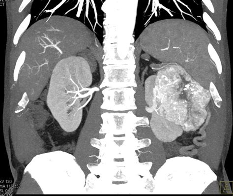 Clear Cell Renal Cell Carcinoma Left Kidney Kidney Case Studies
