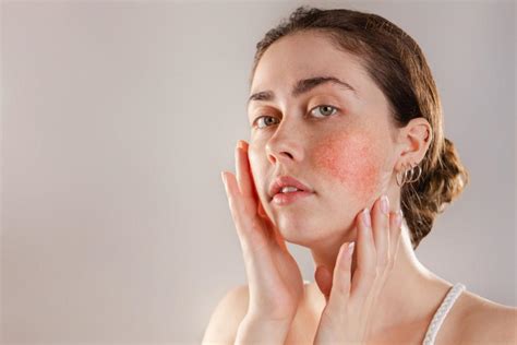 The 5 Most Common Rosacea Triggers Hines Dermatology Associates Inc