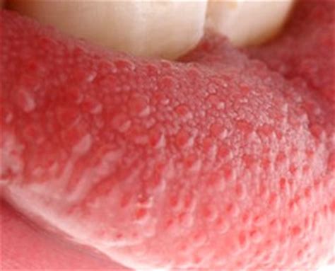 How long does a lie bump last? Pimple on Tongue | Med Health Daily