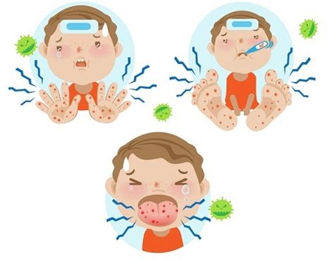 Hand Foot Mouth Disease Ira Childrens Clinic