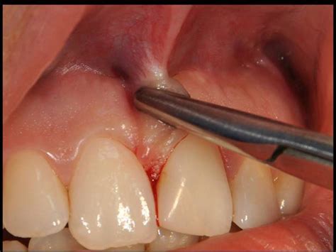 labial frenectomy with nd yag laser and conventional surgery