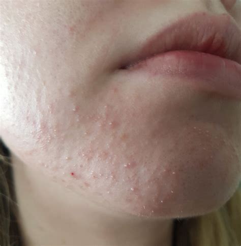 From Fungal Acne Folliculitis To Clear Skin With Pictures Skin Careless