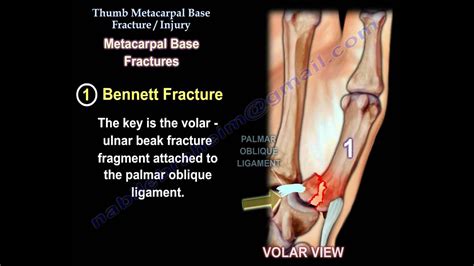 Thumb Metacarpal Base Fracture Injury Everything You Need To Know