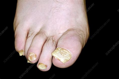 Psoriasis Of The Toenails Stock Image C0169271 Science Photo Library