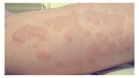 Red Bumps On Arms Not Itchy