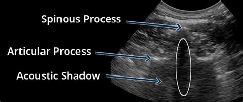 Transverse Conventional Ultrasound Spinous Process