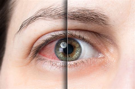If the eyes are looking directly at. Pink Eye Facts: Symptoms, Causes, Treatments - Sand Canyon ...