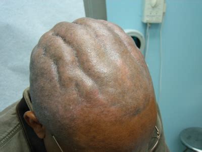 There are several factors linked to hair loss. Thick ridges and valleys found on a newly shaved scalp ...