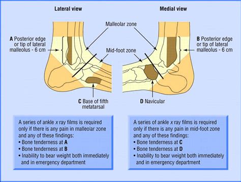 Sprained Ankle Explained