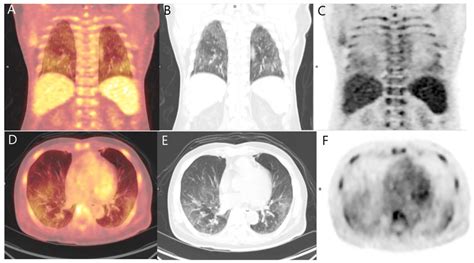 Diagnostics Free Full Text Metastatic Pulmonary Calcification