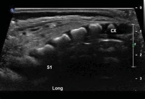 Ultrasound Examination Of The Neonatal Spine Fitzgerald