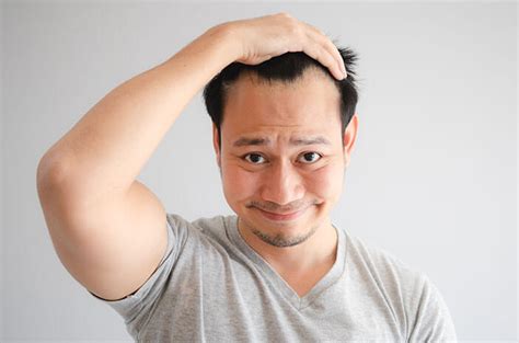 Cegah Botak Ini Cara Mengatasi Rambut Rontok