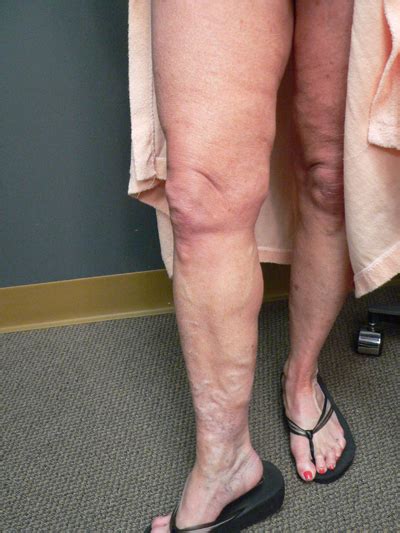 Nature Of Varicose Veins Factors Contributing To Their