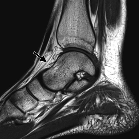 Mr Imaging Of Entrapment Neuropathies Of The Lower Extremity