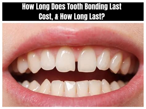 How Long Does Tooth Bonding Last Cost And How Long Last
