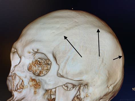 Anatomy Of The Bony Temporal Line Of The Skull Front View Dr Barry