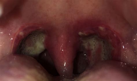 Day 12 Post Tonsillectomy Note In Comments Tonsilstones