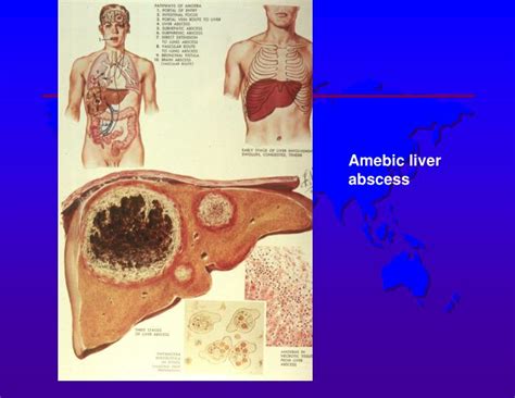 Ppt Amebiasis Powerpoint Presentation Id3484627