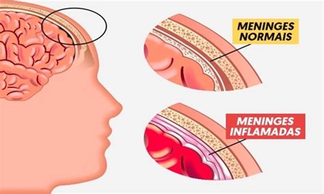 A meningite é um processo inflamatório das meninges membranas que