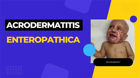 What Is Acrodermatitis Enteropathica Symptoms Of Acrodermatitis