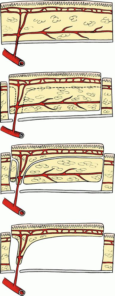 Anterior Supramalleolar Perforator Flap Plastic Surgery Key