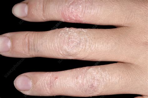 Acute Eczema Stock Image C0294903 Science Photo Library