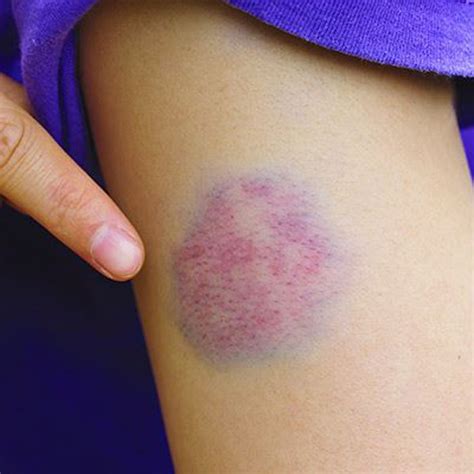 Reasons For Constant Bruises On Your Body नील के निशान Bruise Marks